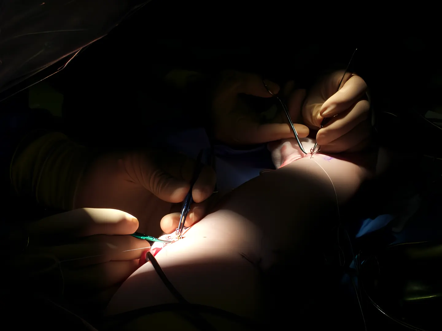 Close-up of a microsurgical procedure: the surgeons' gloved hands suture under a single focused light